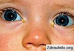 Dlaczego oczy noworodka wydają się słabe? Co powinienem zrobić w takich przypadkach? Niż w leczeniu choroby?: dlaczego
